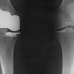 Knee X-ray